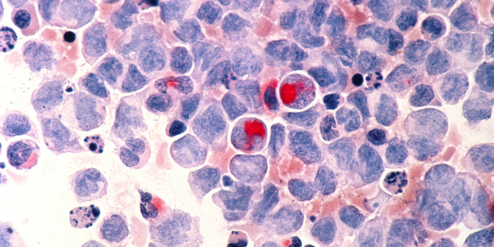 Fevereiro Laranja conscientiza sobre importância da doação de medula